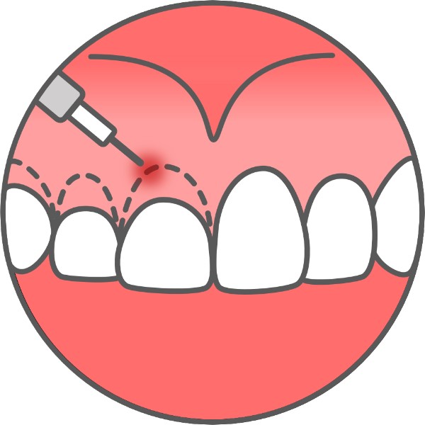 gingiva1.jpg
                            