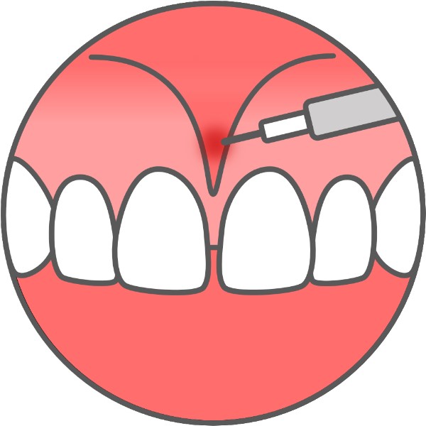 gingiva2.jpg