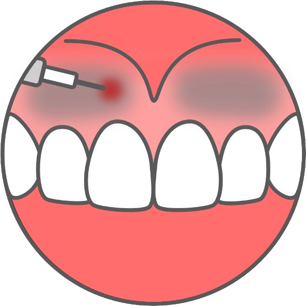 gingiva1.jpg
                            